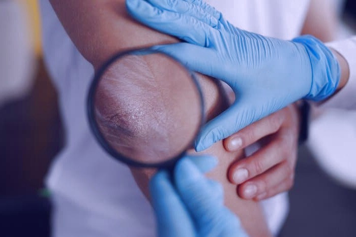 بیماری سلیاک