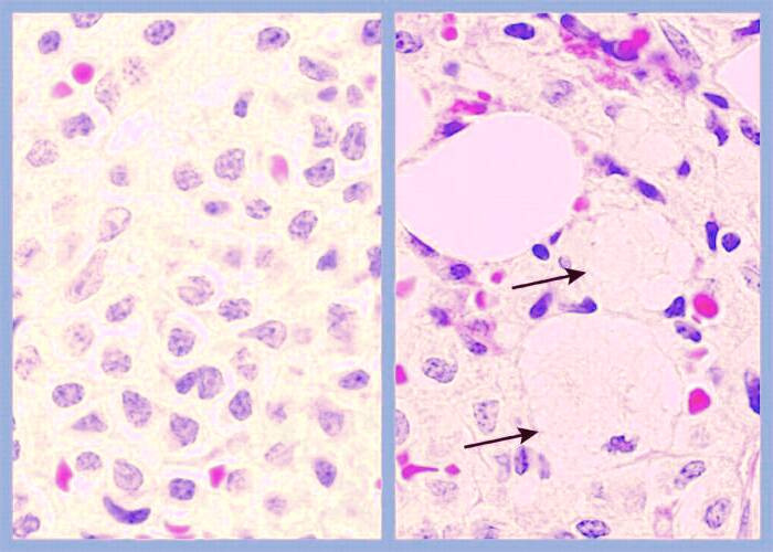 بیماری گوشه
