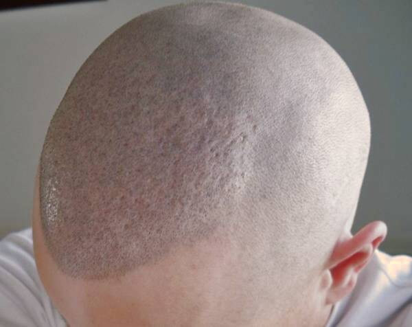 عوارض کاشت مو