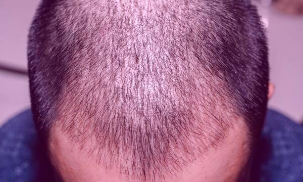 نشانه های عفونت بعد از کاشت مو