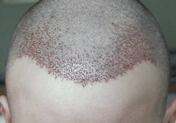 بعد کاشت مو