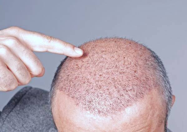 عفونت بعد از کاشت مو