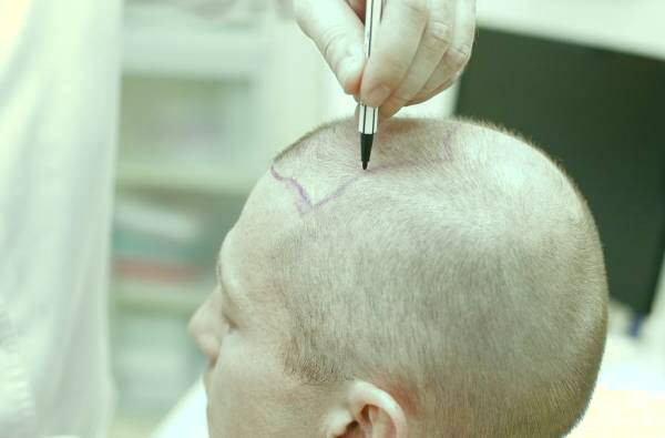 درمان عفونت بعد از کاشت مو