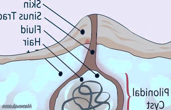 کیست پیلونیدال
