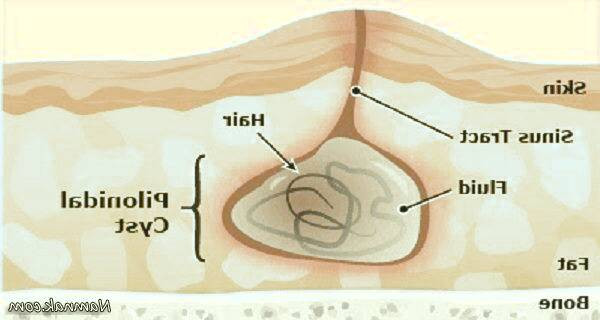 علت ابتلا به کیست مویی 