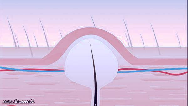  پیشگیری از کیست پیلونیدال