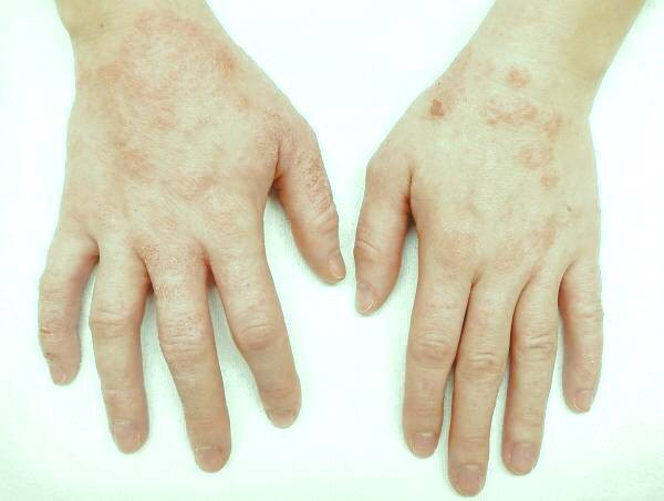 درماتیت تماسی