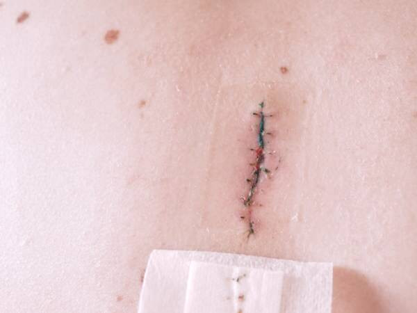 بخیه زدن زخم باز