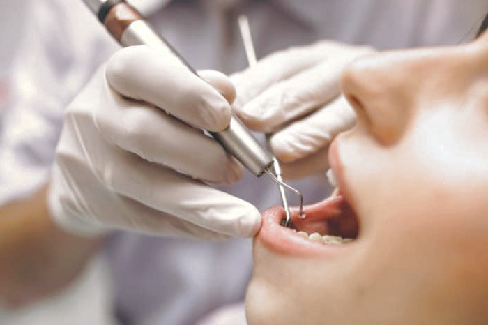 روش باندینگ دندان