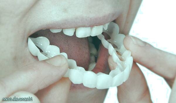 پروتز دندان متحرک 