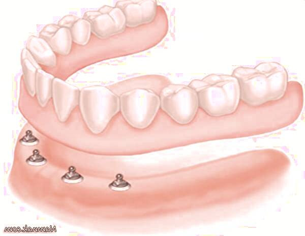 پروتز دندانی متحرک