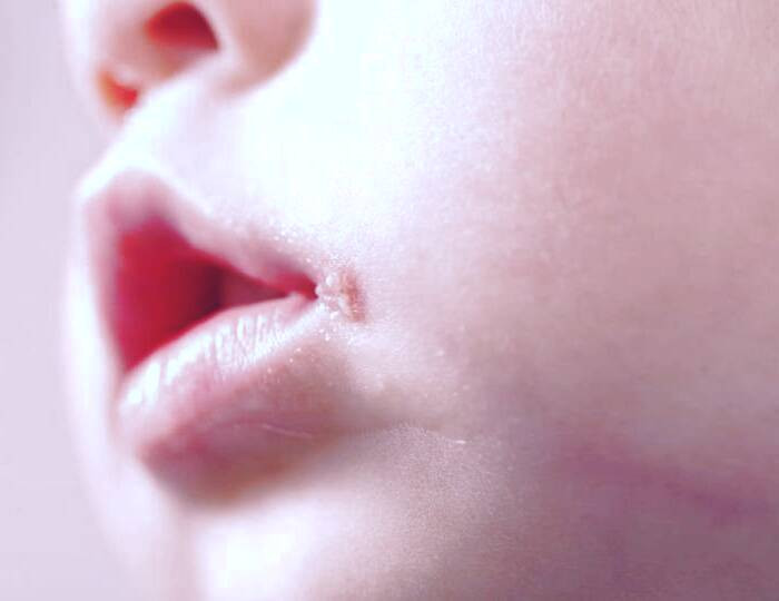 آفت دهان 