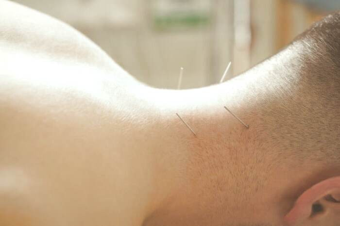طب سوزنی 