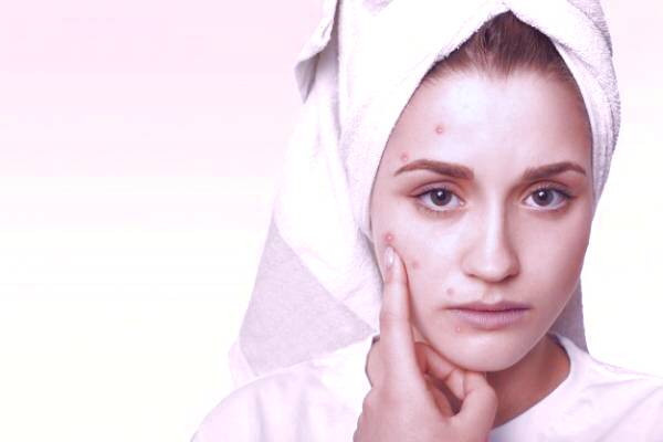 قرص برای جوش