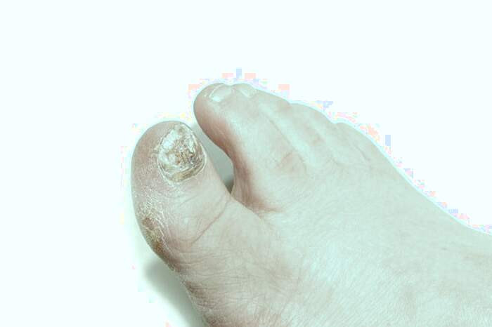 علائم صدف ناخن
