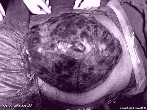 جراحی تومور