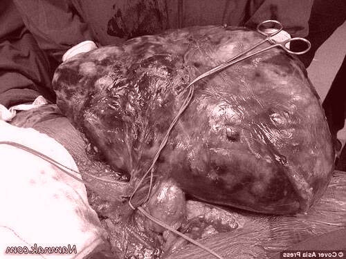 جراحی تومور