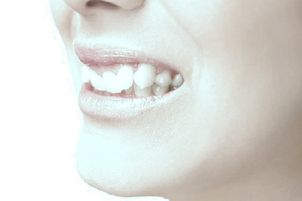 بی نظمی دندان ها