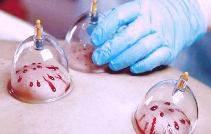 تفاوت اهدای خون و حجامت فواید حجامت