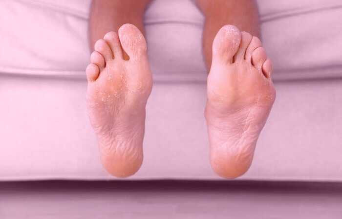 پسوریازیس عامل خارش کف پا پسوریازیس پا