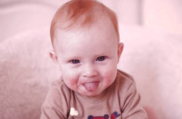 اگزمای آتوپیک اگزما