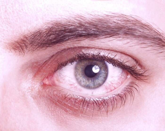 علت قرمز شدن چشم ها چیست  دلیل قرمز شدن چشم ها چیست