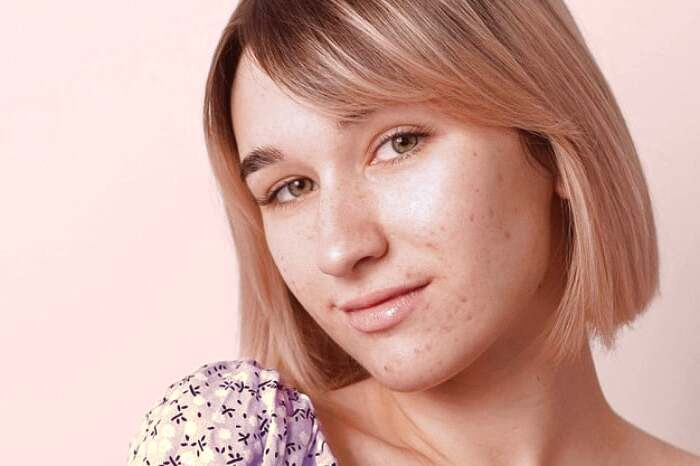 نعناع برای جوش صورت نعناع برای پوست