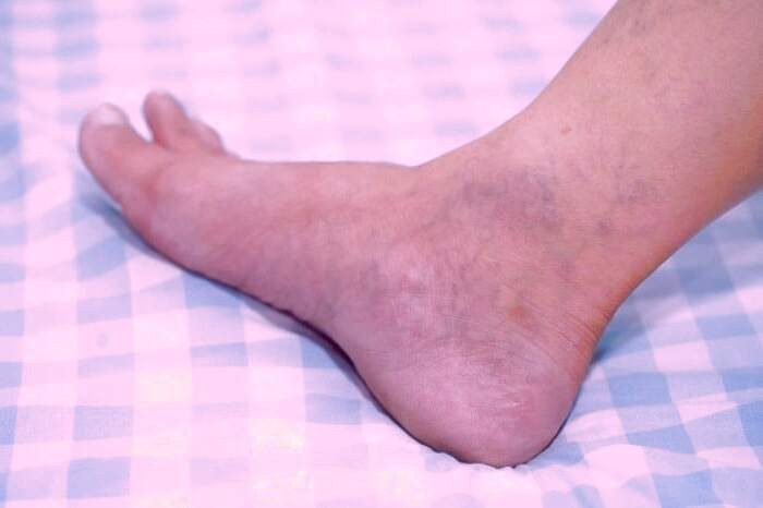 سیاهرگ واریسی