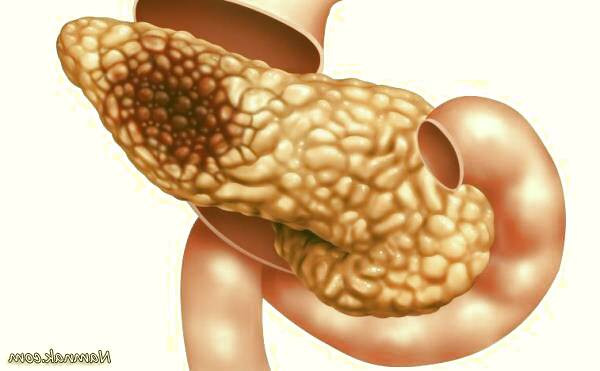 سم زدایی پانکراس