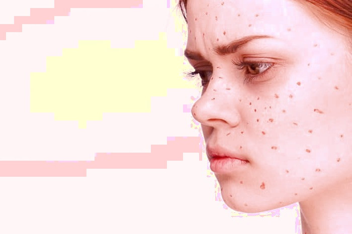 جلوگیری از سرطان پوست 