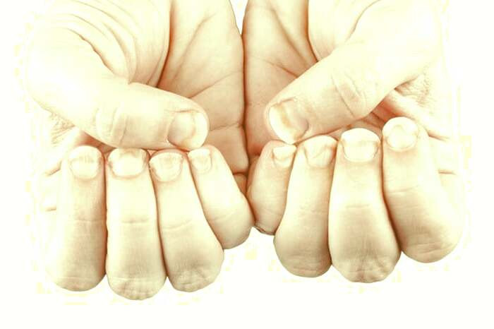 مشکلات ناخن