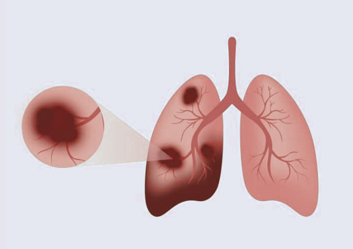 سرطان ریه