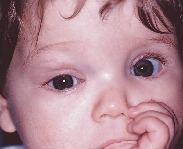 افتادگی پلک یک چشم