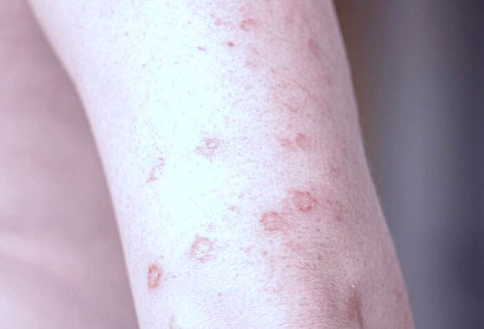 عوارض عرق سوز شدن