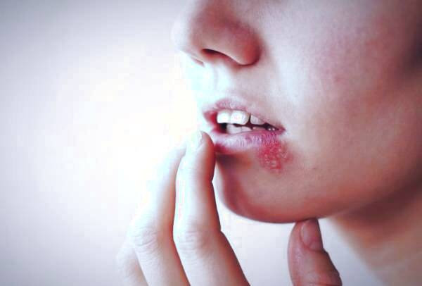 انواع تبخال