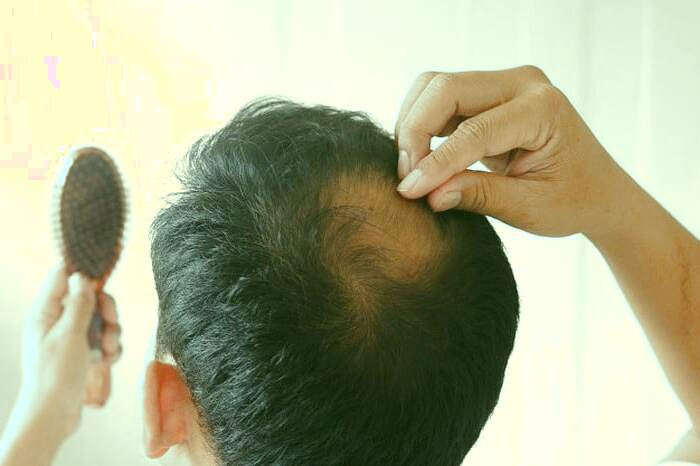 ریزش مو در جوانی