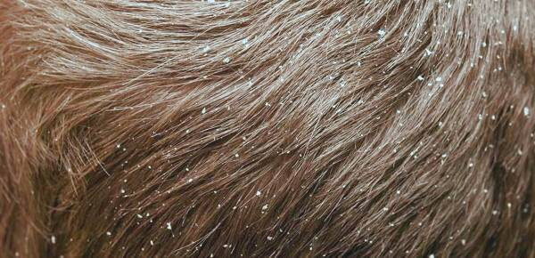 ترنجبین برای شوره سر 