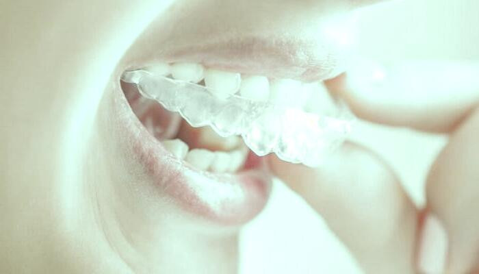 ارتودنسی نامرئی