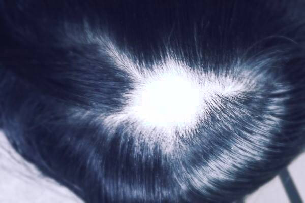 کچلی سکه ای ریش