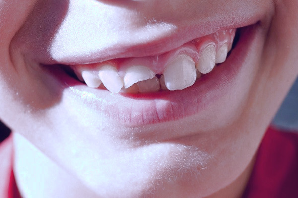 بهترین سن برای ایمپلنت دندان