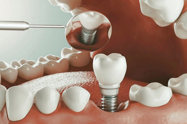 بهترین سن برای ایمپلنت دندان