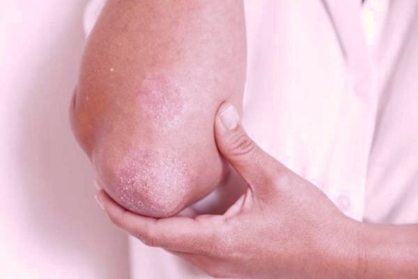 رفع قارچ پوستی