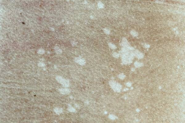 علت قارچ پوستی