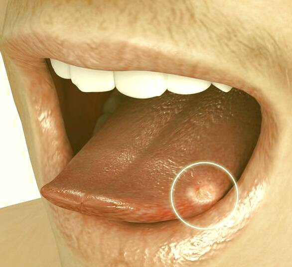 لکه روی زبان