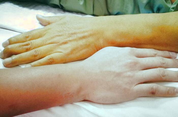 انواع بیماری یرقان