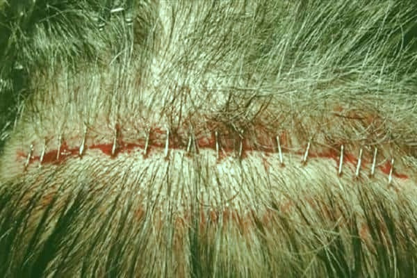 عوارض کاشت مو: نکاتی که پزشکان ممکن است به شما نگویند