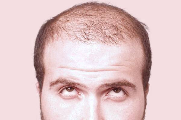 عوارض کاشت مو: نکاتی که پزشکان ممکن است به شما نگویند