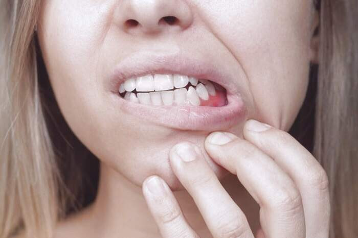 رنگ پریدگی لثه