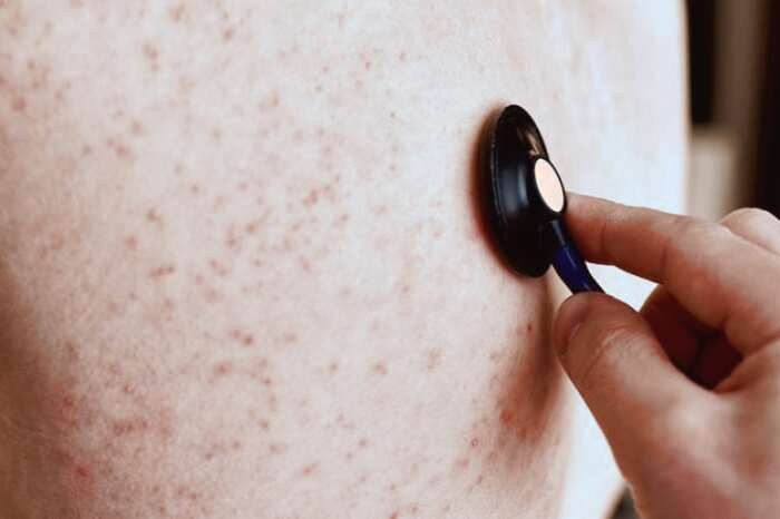 عامل ایجاد آکنه