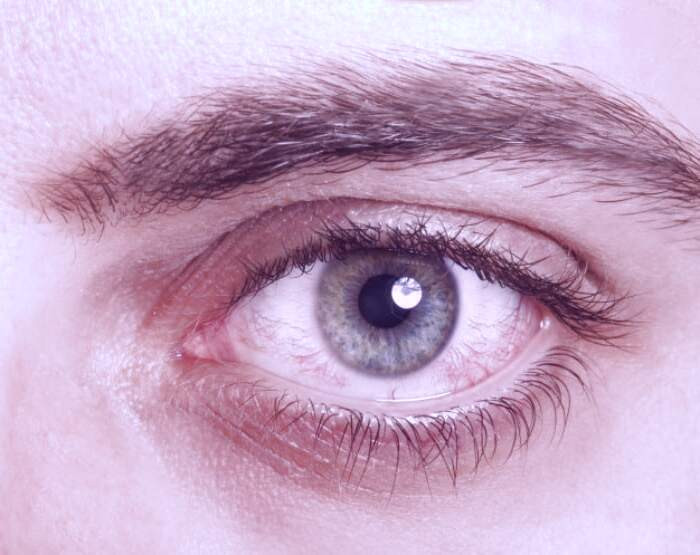 التهاب ملتحمه